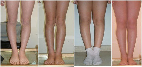 Behandlung / Korrektur von O-Beinen bei Kindern