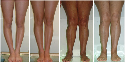 Behandlung von O-Beinen und X-Beinen